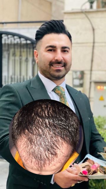 بهترین کلینیک کاشت مو در پارس آباد 