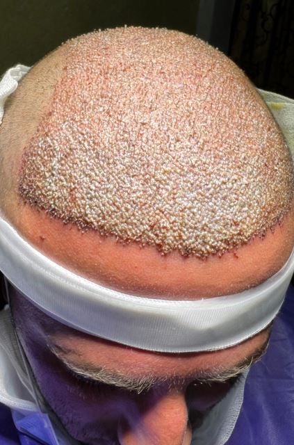 بهترین کلینیک کاشت مو در پارس آباد 