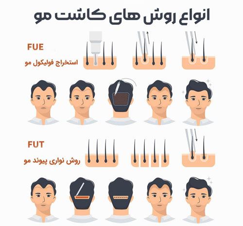 بهترین کلینیک کاشت مو در پارس آباد 