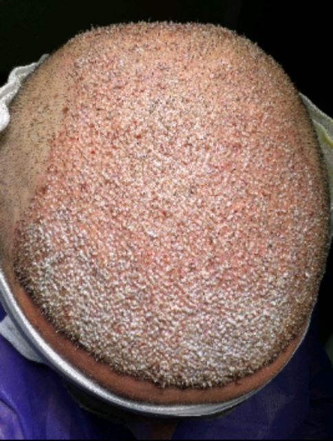 بهترین کلینیک کاشت مو در پارس آباد 