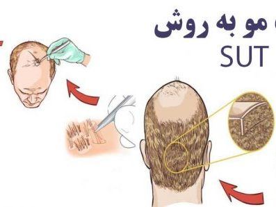 بهترین کلینیک کاشت مو در پارس آباد 