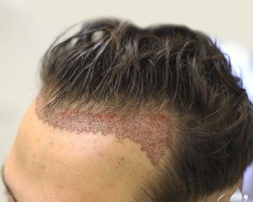 بهترین کلینیک کاشت مو در پارس آباد 