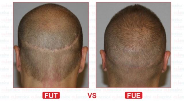 بهترین کلینیک کاشت مو در پارس آباد 