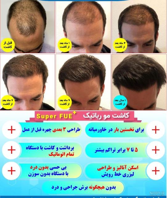 بهترین کلینیک کاشت مو در پارس آباد 