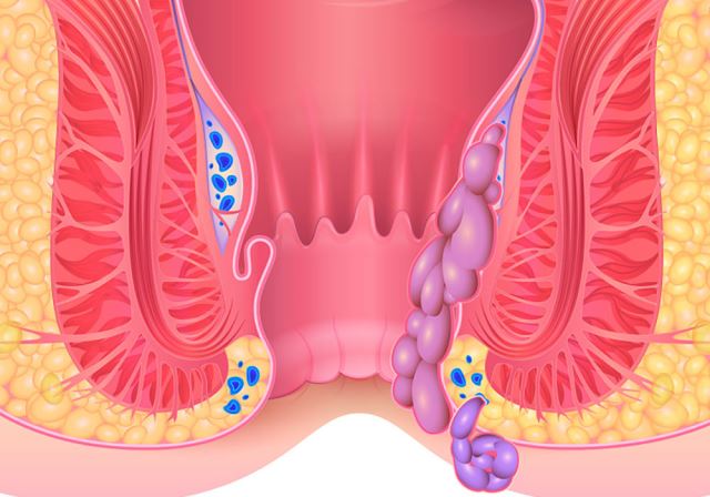لیزر همورویید در اصفهان 