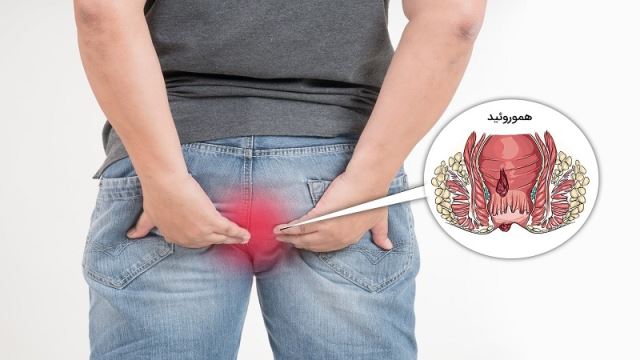 لیزر همورویید در اصفهان 