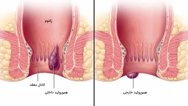 لیزر همورویید در اصفهان 