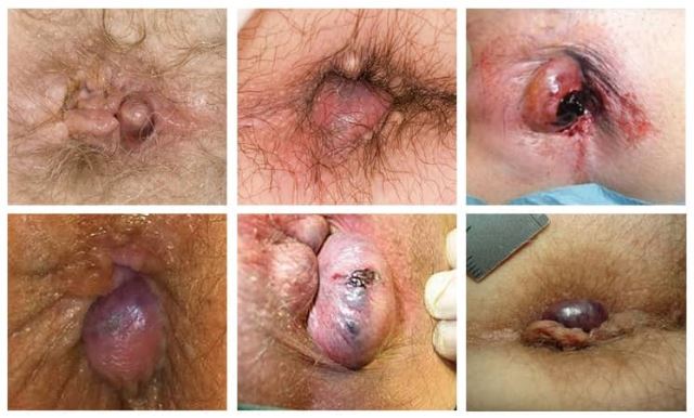 لیزر همورویید در اصفهان 