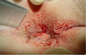 لیزر همورویید در اصفهان 