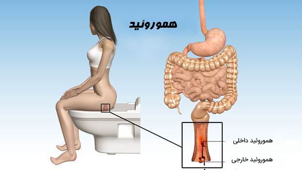 لیزر همورویید در اصفهان 