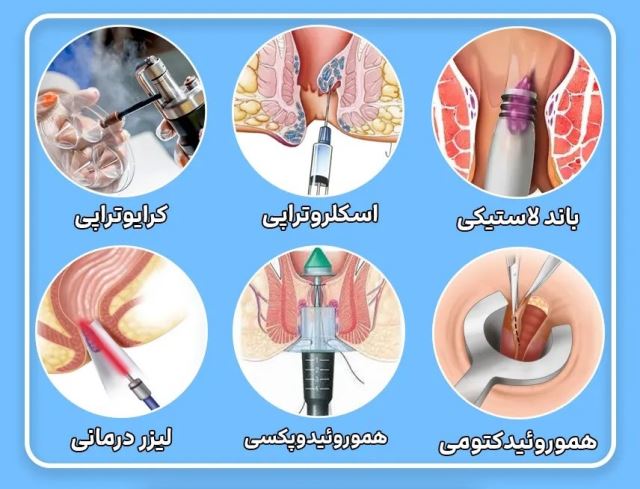 لیزر بواسیر در اصفهان 