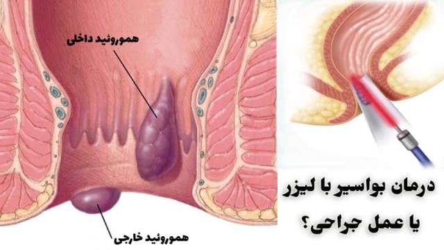 لیزر بواسیر در اصفهان 