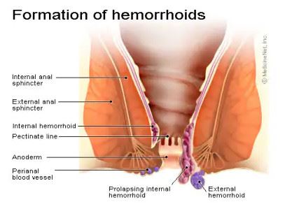 لیزر بواسیر در اصفهان 