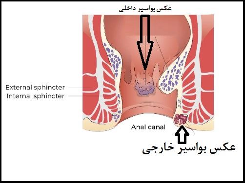 لیزر بواسیر در اصفهان 