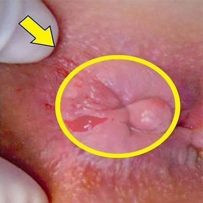 لیزر مقعد در اصفهان 