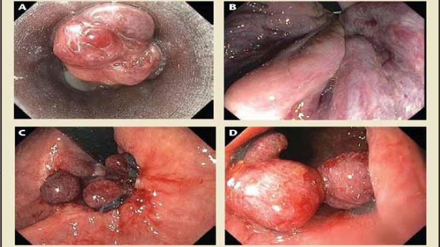 لیزر مقعد در اصفهان 