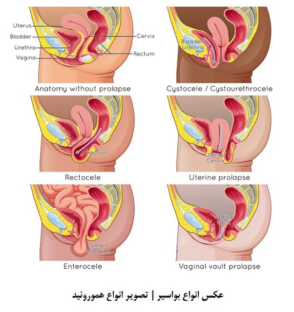 لیزر مقعد در اصفهان 