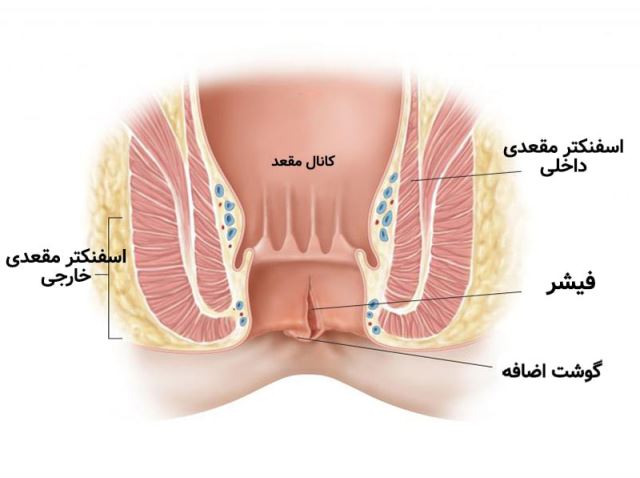 لیزر فیستول در اصفهان 