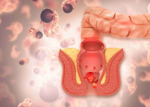 لیزر فیستول در اصفهان 