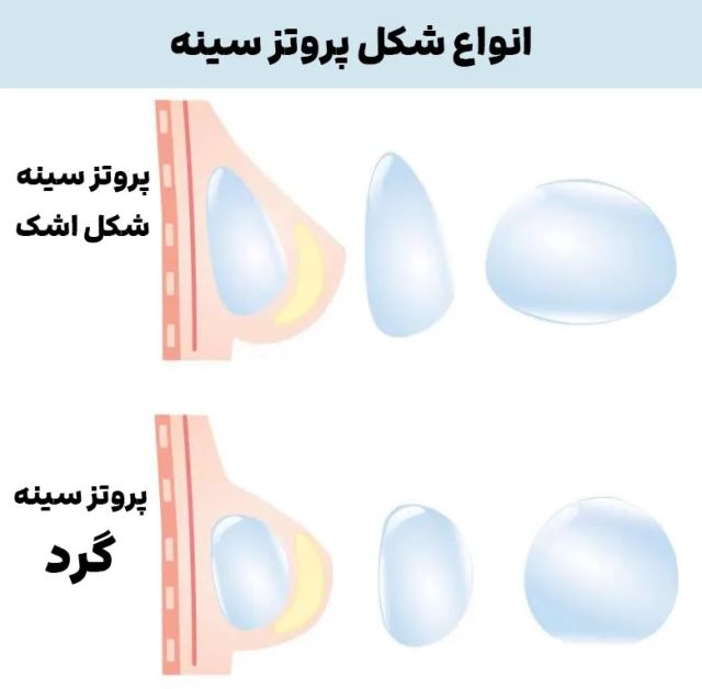 عمل لیزر سینه در اصفهان 