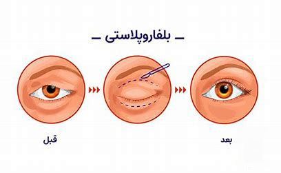 جراحی زیبایی پلک در اصفهان