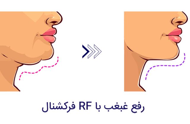 رفع غبغب در اصفهان