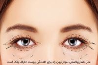 درمان افتادگی پوست صورت در اصفهان