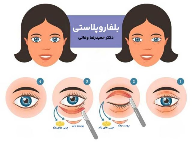 درمان افتادگی پوست صورت در اصفهان