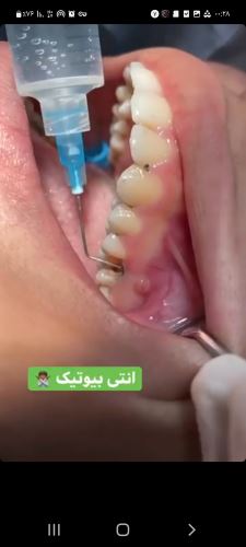 متخصص عصب کشی در ساوه