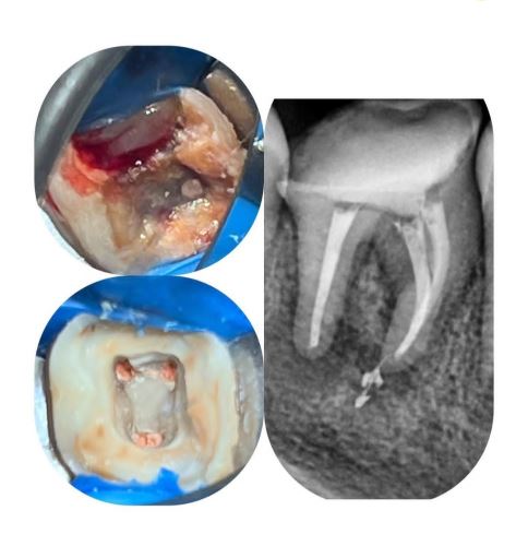 درمان ریشه مولر اول فک پایین
وارم ورتیکال ابچوریشن