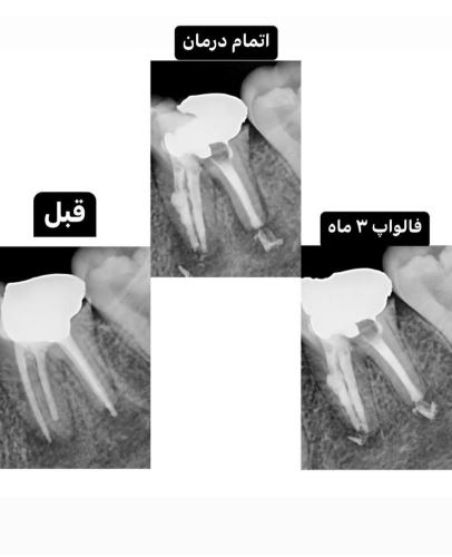 درمان مجدد دندان مولر اول فک پایین با تحلیل داخلی و وسعت ضایعه بسیار، تمامی کانال ها به صورت کامل با سرامیک سرد ابچوره شد.