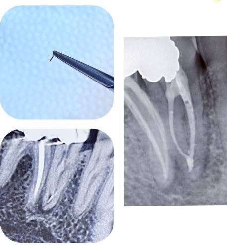 خروج فایل شکسته از دندان پره مولر فک پایین