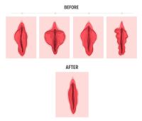 هزینه لابیاپلاستی در تهران