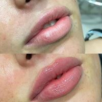 فیلر لب