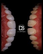 بهترین دکتر برای کامپوزیت در اصفهان