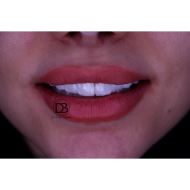 روکش زیرکونیا در اصفهان