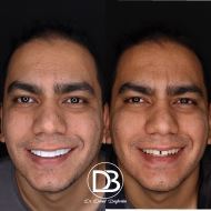 ایمپلنت در اصفهان