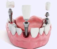 ایمپلنت دندان در اصفهان