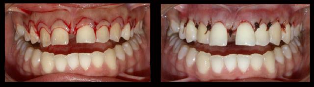 لیفت لثه در اصفهان