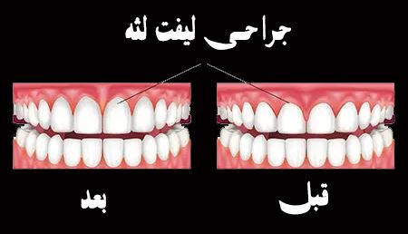 لیفت لثه در اصفهان