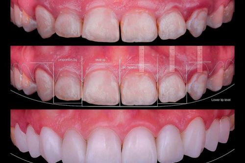 جراحی لثه در اصفهان