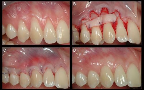 جراحی لثه در فولادشهر