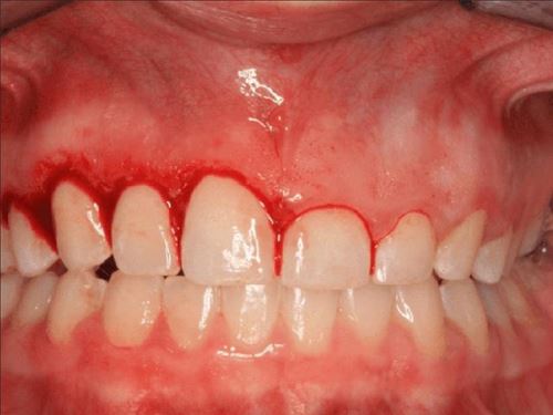 لیفت لثه در اصفهان