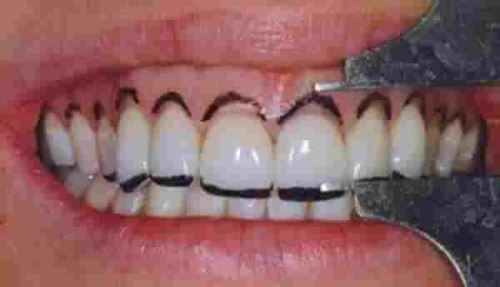 جراحی لثه در شهرکرد