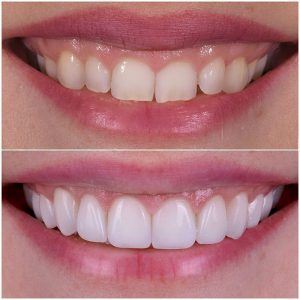 لیفت لثه در شهرکرد