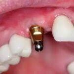 کاشت دندان در یک روز در اصفهان