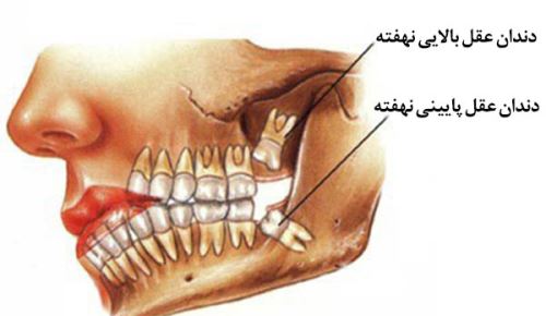 جراحی دندان عقل در اصفهان