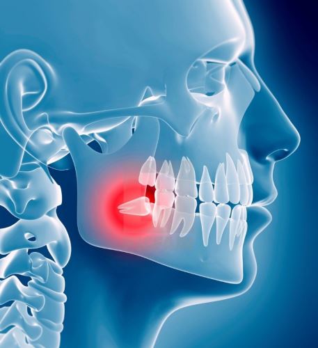 جراحی دندان عقل در زرین شهر