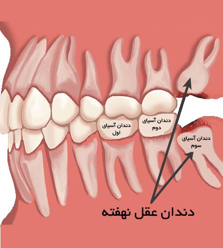 بهترین دکتر جراحی دندان عقل در اصفهان