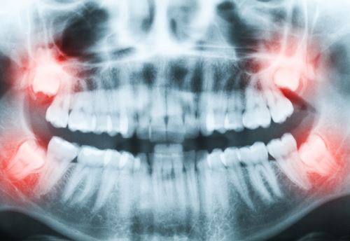 جراحی دندان عقل در شهرکرد